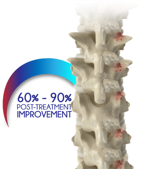Spinal Stenosis Post-Treatment Improvement-300x308